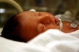 Membrana hialina o distress respiratorio neonatal