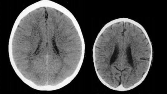 Desarrollo del cerebro recién nacido. Negligencia en la privación sensorial