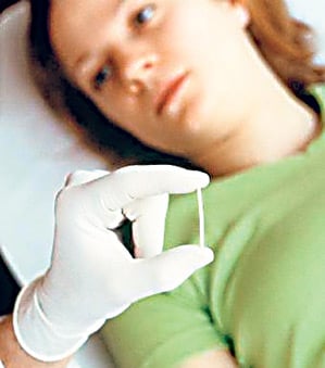Implante anticonceptivo
